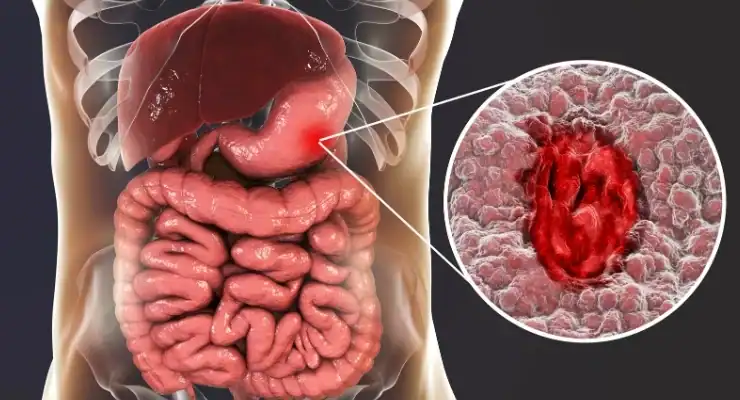 Illustration of human digestive system highlighting a stomach ulcer, with an arrow pointing to the affected area and a magnified inset showing inflamed tissue.